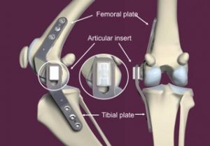 simitri implant